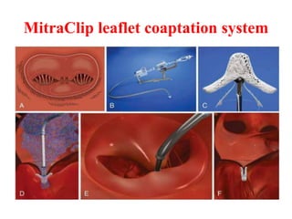 MitraClip leaflet coaptation system
 