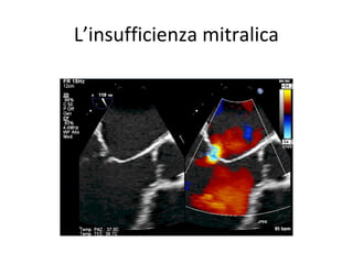 L’insufficienza mitralica
 