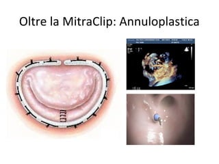 Oltre la MitraClip: Annuloplastica
 