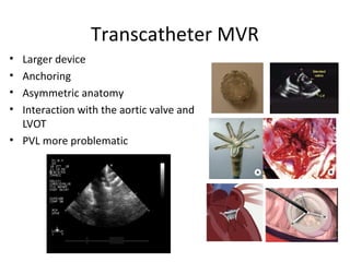 Transcatheter MVR
• Larger device
• Anchoring
• Asymmetric anatomy
• Interaction with the aortic valve and
LVOT
• PVL more problematic
 