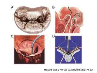Maisano et al, J Am Coll Cardiol 2011;58: 2174–82
 
