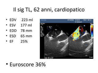 Il sig TL, 62 anni, cardiopatico
• EDV 223 ml
• ESV 177 ml
• EDD 78 mm
• ESD 65 mm
• EF 25%
• Euroscore 36%
 