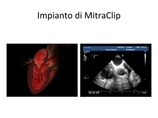 Impianto di MitraClip
 