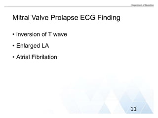 Mitral Valve Prolapse ECG Finding
• inversion of T wave
• Enlarged LA
• Atrial Fibrilation
11
 