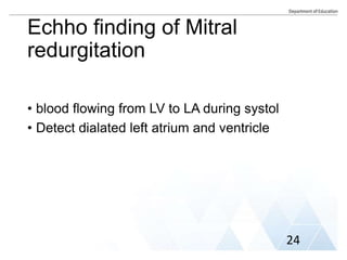 Echho finding of Mitral
redurgitation
• blood flowing from LV to LA during systol
• Detect dialated left atrium and ventricle
24
 