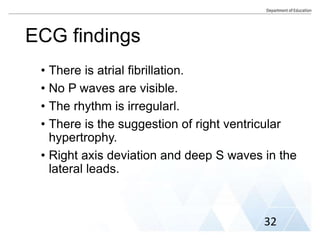 ECG findings
• There is atrial fibrillation.
• No P waves are visible.
• The rhythm is irregularl.
• There is the suggestion of right ventricular
hypertrophy.
• Right axis deviation and deep S waves in the
lateral leads.
32
 
