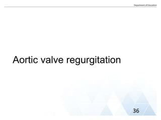 Aortic valve regurgitation
36
 
