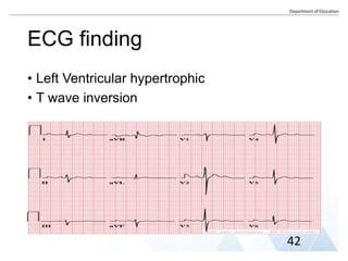 ECG finding
• Left Ventricular hypertrophic
• T wave inversion
42
 