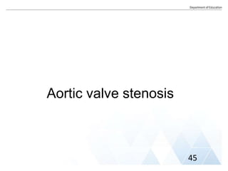 Aortic valve stenosis
45
 