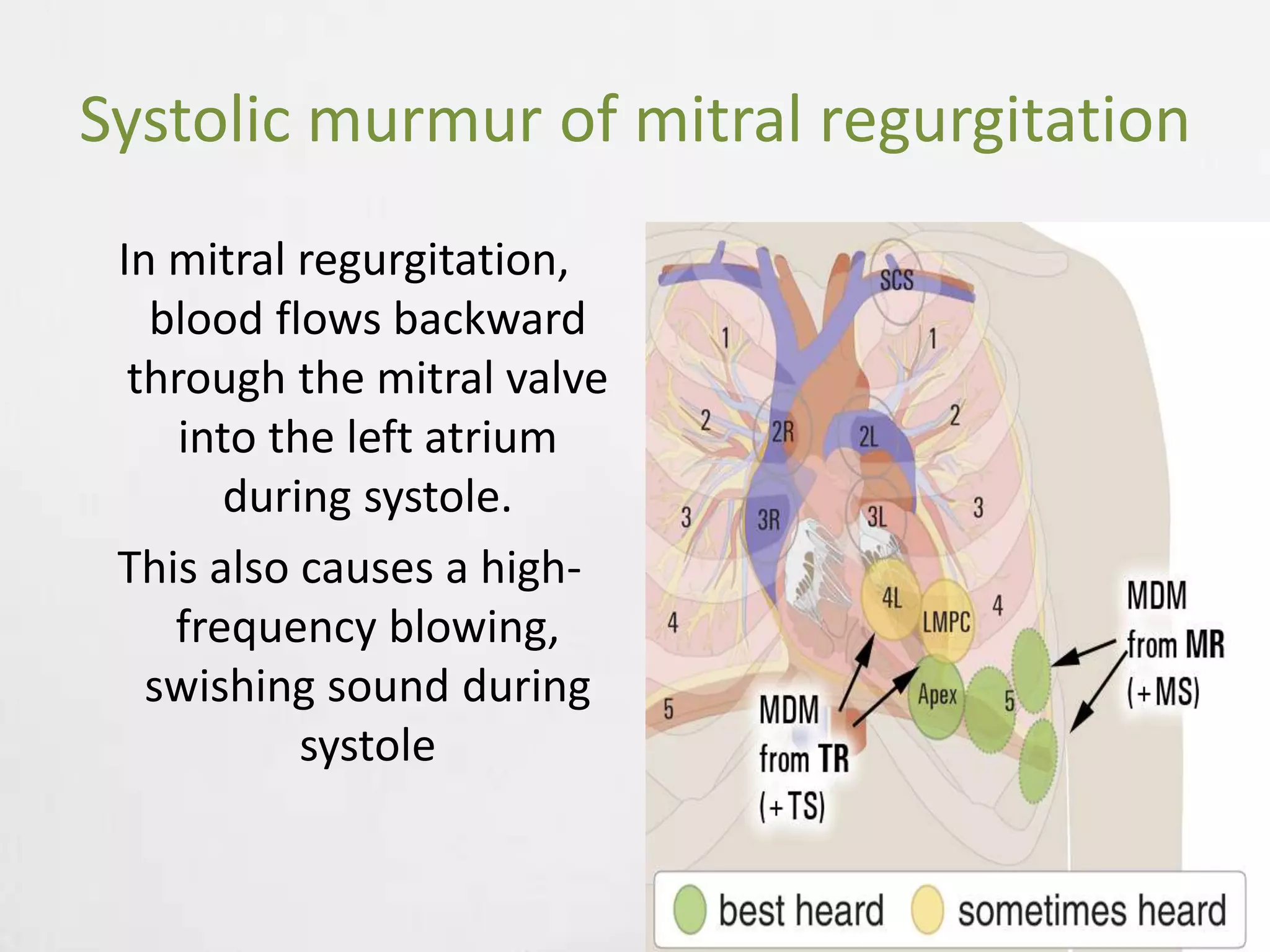 Mitral regurgitation | PPTX