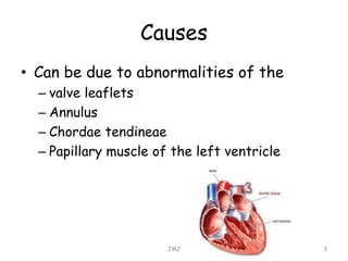 Causes
• Can be due to abnormalities of the
– valve leaflets
– Annulus
– Chordae tendineae
– Papillary muscle of the left ventricle
JMJ 3
 