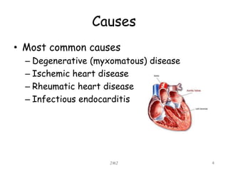 Causes
• Most common causes
– Degenerative (myxomatous) disease
– Ischemic heart disease
– Rheumatic heart disease
– Infectious endocarditis
JMJ 4
 