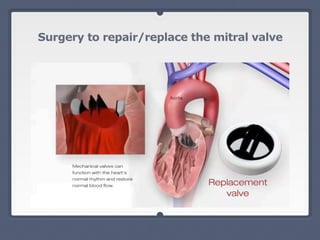 Surgery to repair/replace the mitral valve
 