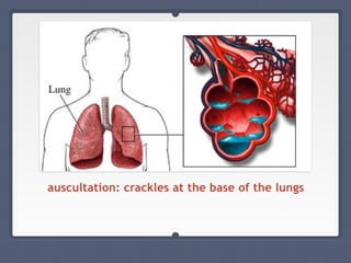 auscultation: crackles at the base of the lungs
 