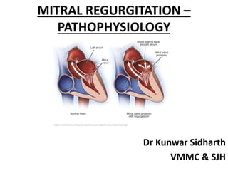 MITRAL REGURGITATION –
PATHOPHYSIOLOGY
Dr Kunwar Sidharth
VMMC & SJH
 
