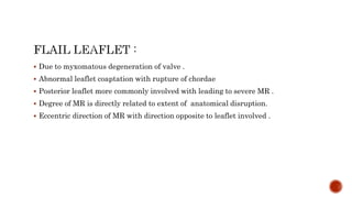  Due to myxomatous degeneration of valve .
 Abnormal leaflet coaptation with rupture of chordae
 Posterior leaflet more commonly involved with leading to severe MR .
 Degree of MR is directly related to extent of anatomical disruption.
 Eccentric direction of MR with direction opposite to leaflet involved .
 