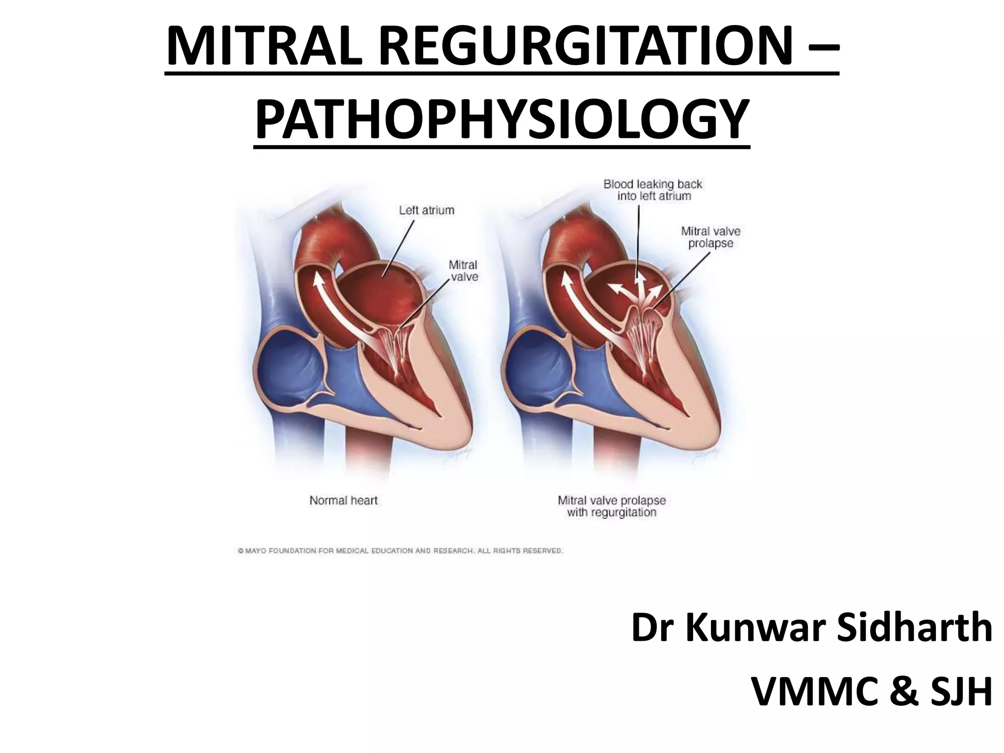 MITRAL REGURGITATION –
PATHOPHYSIOLOGY
Dr Kunwar Sidharth
VMMC & SJH