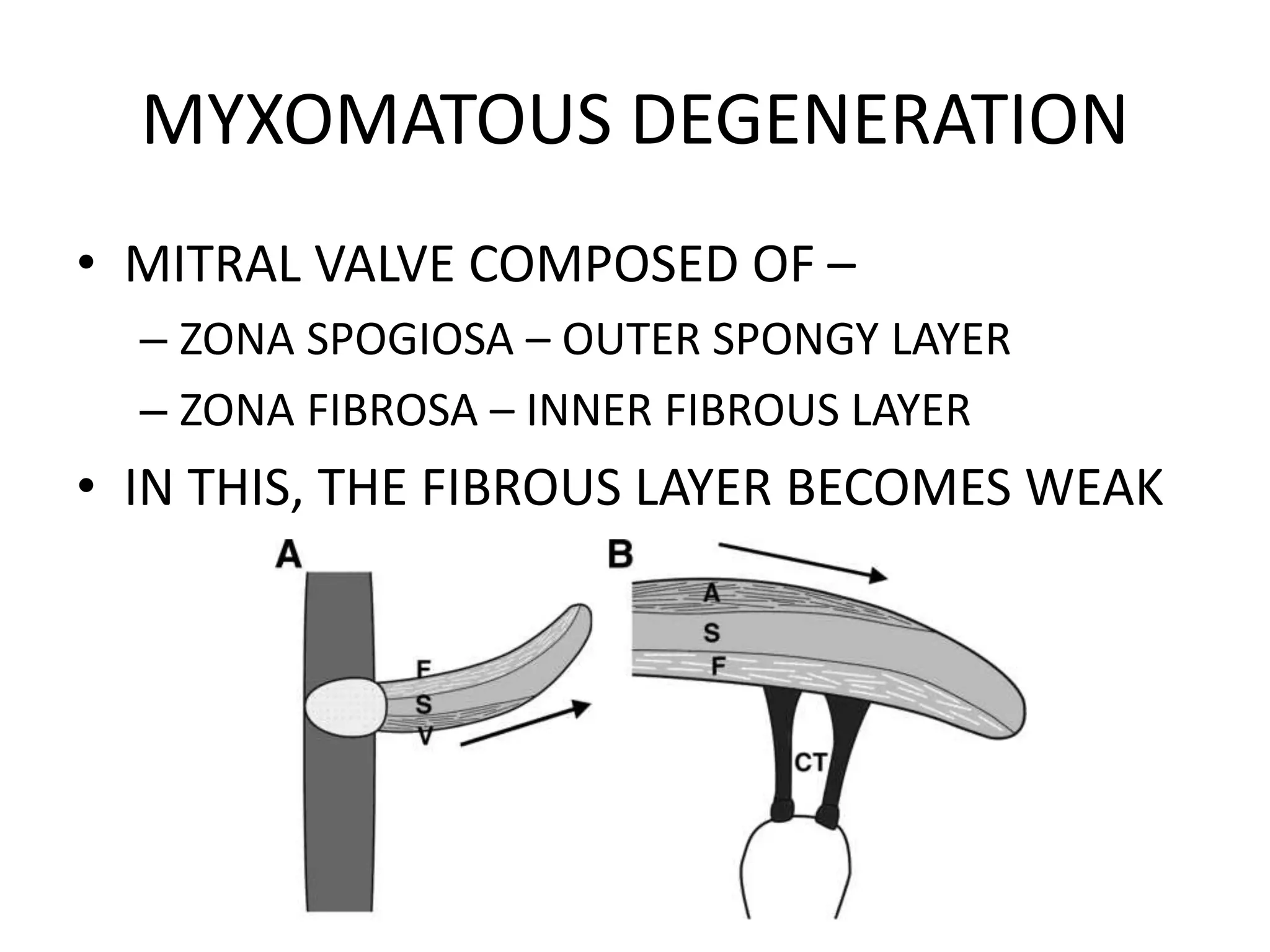MYXOMATOUS DEGENERATION
• MITRAL VALVE COMPOSED OF –
– ZONA SPOGIOSA – OUTER SPONGY LAYER
– ZONA FIBROSA – INNER FIBROUS LAYER
• IN THIS, THE FIBROUS LAYER BECOMES WEAK