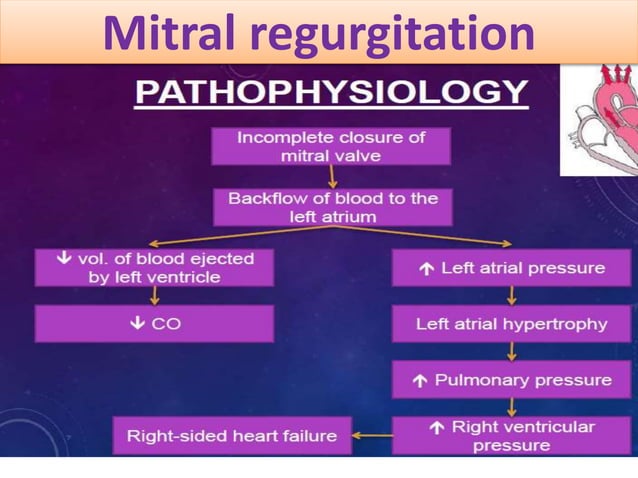mitral-regurgitation-for-post-graduates-ppsx