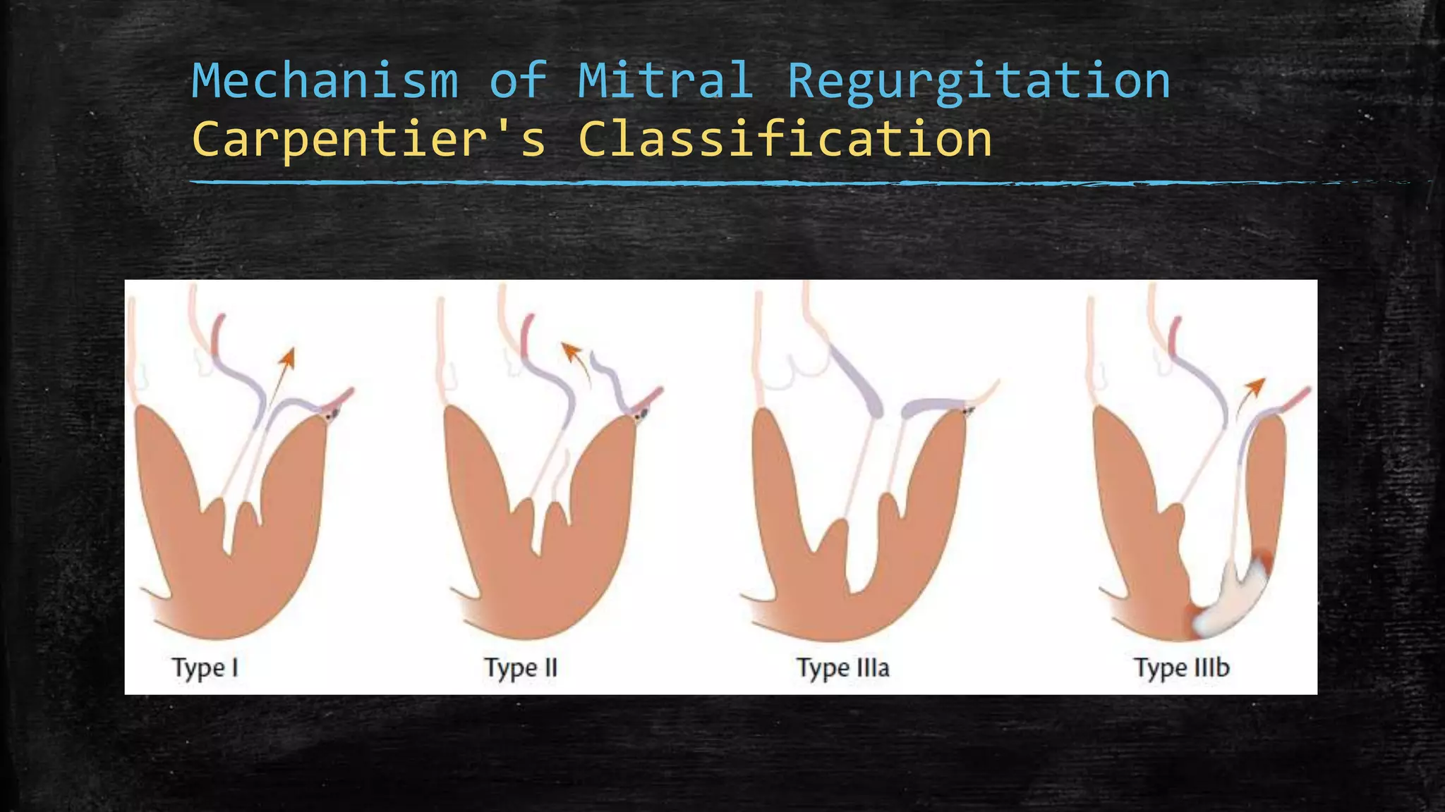 Echocardiography of Mitral regurgitation | PPTX