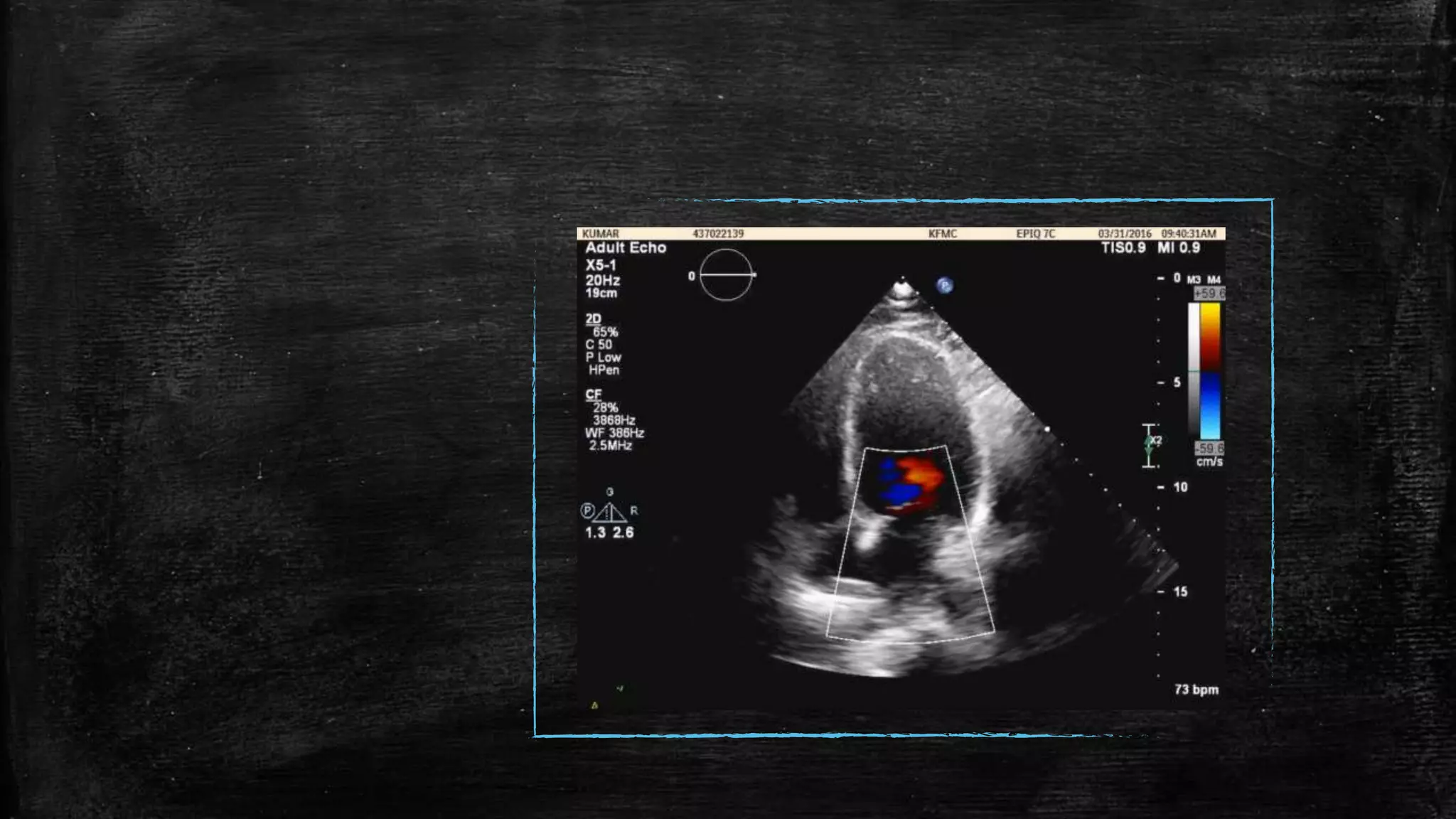 Echocardiography of Mitral regurgitation | PPTX