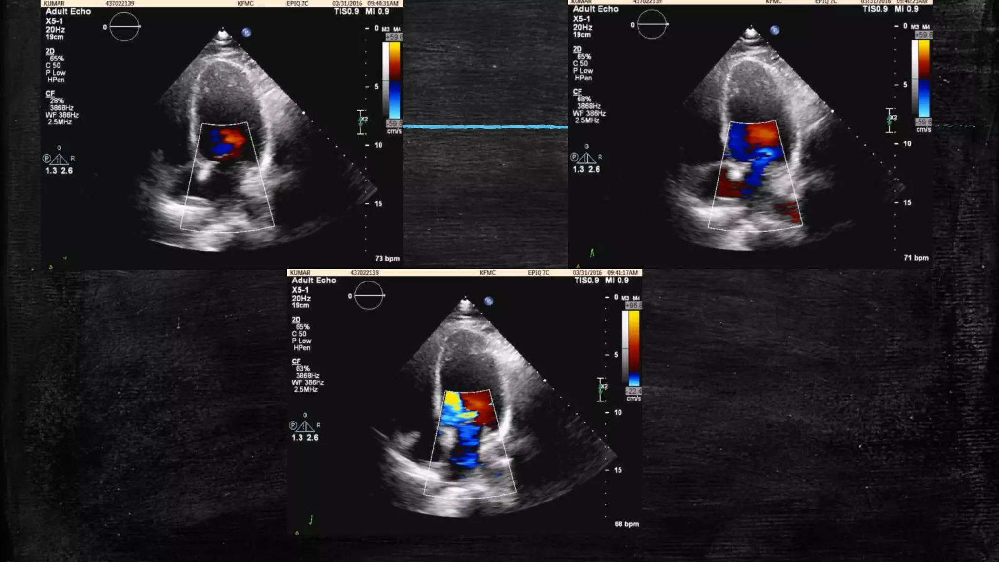Echocardiography of Mitral regurgitation | PPTX