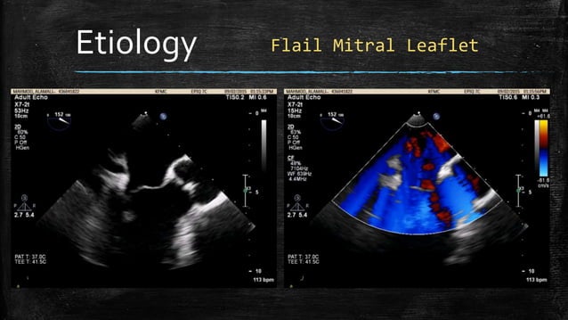 Echocardiography of Mitral regurgitation | PPTX | Heart and ...