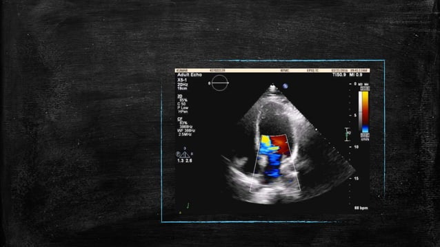 Echocardiography of Mitral regurgitation | PPTX | Heart and ...