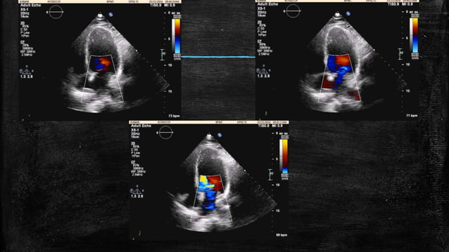 Echocardiography of Mitral regurgitation | PPTX | Heart and ...
