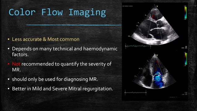 Echocardiography of Mitral regurgitation | PPTX | Heart and ...