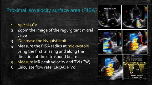 Echocardiography of Mitral regurgitation | PPTX | Heart and ...