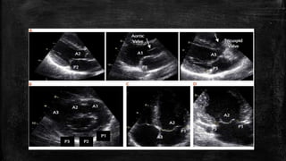 Echocardiography of Mitral regurgitation | PPTX