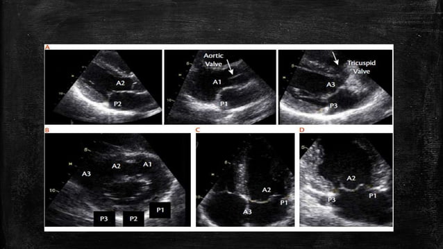 Echocardiography of Mitral regurgitation | PPTX | Heart and ...