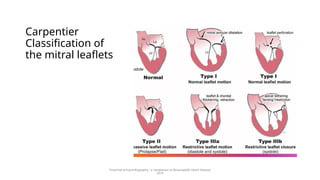 Carpentier
Classification of
the mitral leaflets
Essential echocardiography : a companion to Braunwald’s Heart disease
2019
 
