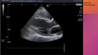 Video Coutresy of Cardiodynamic Athens YouTube cha
nnel
Barlow’s
Disease Echo.
 