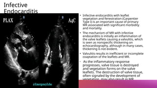 Infective
Endocarditis
• Infective endocarditis with leaflet
vegetation and fenestration (Carpentier
Type I) is an important cause of primary
MR associated with significant morbidity
and mortality.
• The mechanism of MR with infective
endocarditis is initially an inflammation of
the valve leaflets causing a valvulitis, which
is seen as nonspecific thickening on
echocardiography, although in many cases,
thickening is not evident.
• Valvulitis results in inefficient or incomplete
coaptation of the leaflets and MR.
• As the inflammatory response
progresses, valve tissue is destroyed
and vegetation forms on the valve
leaflets. The destruction of valve tissue,
often signaled by the development of
vegetation, may also result in MR
 