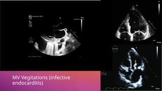 MV Vegitations (infective
endocarditis)
 
