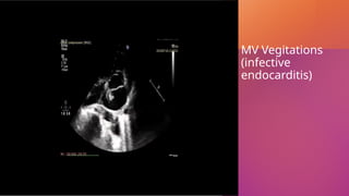 MV Vegitations
(infective
endocarditis)
 