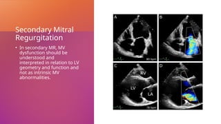 Secondary Mitral
Regurgitation
• In secondary MR, MV
dysfunction should be
understood and
interpreted in relation to LV
geometry and function and
not as intrinsic MV
abnormalities.
 