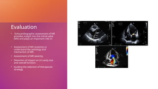 Evaluation
• Echocardiographic assessment of MR
provides insight into the mitral valve
(MV) and plays an important role in:
• Assessment of MV anatomy to
understand the aetiology and
mechanism of MR.
• Assessment of MR severity.
• Detection of impact on LV cavity size
and overall function.
• Guiding the selection of therapeutic
strategy.
 