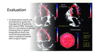 Evaluation
• LV dimensions and EF are
considered to guide the
management of patients
with severe PMR. However,
there is cumulative evidence
showing that LV global
longitudinal strain has
incremental prognostic
value in patients treated
with surgical repair.
 