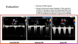 Evaluation • Density of MR signals
• Using continuous wave Doppler, if the signal is
similar in density to that of antegrade flow, this
suggests significant MR, whereas a faint signal
or an incomplete envelope is typical of mild MR
 