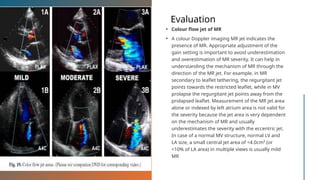 Evaluation
• Colour flow jet of MR
• A colour Doppler imaging MR jet indicates the
presence of MR. Appropriate adjustment of the
gain setting is important to avoid underestimation
and overestimation of MR severity. It can help in
understanding the mechanism of MR through the
direction of the MR jet. For example, in MR
secondary to leaflet tethering, the regurgitant jet
points towards the restricted leaflet, while in MV
prolapse the regurgitant jet points away from the
prolapsed leaflet. Measurement of the MR jet area
alone or indexed by left atrium area is not valid for
the severity because the jet area is very dependent
on the mechanism of MR and usually
underestimates the severity with the eccentric jet.
In case of a normal MV structure, normal LV and
LA size, a small central jet area of <4.0cm² (or
<10% of LA area) in multiple views is usually mild
MR
 
