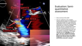 Evaluation: Semi-
quantitative
assessment
• Vena contracta (VC) width
• The VC is defined as the smallest,
highest-velocity region of a flow jet and
is typically located at or just below the
regurgitant orifice. Its width should be
measured in a long-axis imaging plane
perpendicular to the mitral leaflet
closure. The VC is independent of flow
rate and driving pressure. It can be
used for central and eccentric jets and
is accurate in acute MR. However, it is
not valid for multiple jets. A VC width
<0.3 cm denotes mild MR and a VC
width >0.7 cm is specific for severe
MR. Intermediate values of VC width
(0.3-0.7 cm) do not mean that MR is
moderate; confirmation by other
quantitative methods is needed
 