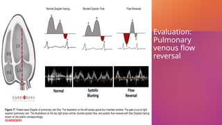 Evaluation:
Pulmonary
venous flow
reversal
 