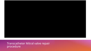 Transcatheter Mitral valve repair
procedure
 