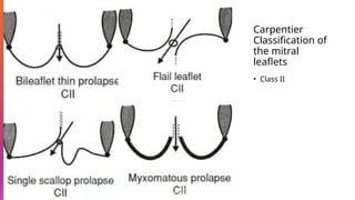 Carpentier
Classification of
the mitral
leaflets
• Class II
Feigenbaum’s echocardiography / William F. Armstrong, Thomas Ryan.
Eighth edition
 