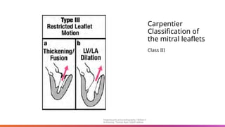 Carpentier
Classification of
the mitral leaflets
Class III
Feigenbaum’s echocardiography / William F.
Armstrong, Thomas Ryan. Eighth edition
 