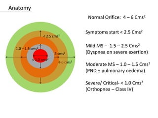 Anatomy
Normal Orifice: 4 – 6 Cms2
4-6 cms2
< 2.5 cms2
1.5- 2.5 cms2
1.0 – 1.5 cms2
< 1.0 cms2
Mild MS – 1.5 – 2.5 Cms2
(Dyspnea on severe exertion)
Moderate MS – 1.0 – 1.5 Cms2
(PND ± pulmonary oedema)
Severe/ Critical- < 1.0 Cms2
(Orthopnea – Class IV)
Symptoms start < 2.5 Cms2
 