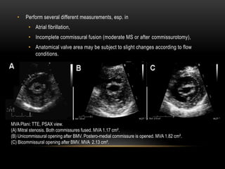 • Perform several different measurements, esp. in
• Atrial fibrillation,
• Incomplete commissural fusion (moderate MS or after commissurotomy),
• Anatomical valve area may be subject to slight changes according to flow
conditions.
MVA Plani: TTE, PSAX view.
(A) Mitral stenosis. Both commissures fused. MVA 1.17 cm².
(B) Unicommissural opening after BMV. Postero-medial commissure is opened. MVA 1.82 cm².
(C) Bicommissural opening after BMV. MVA 2.13 cm².
 